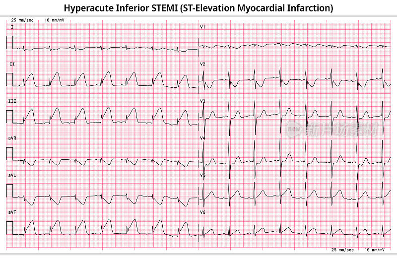 超急性下段STEMI (st段抬高型心肌梗死)- 12导联心电图常见病例- 6秒/导联